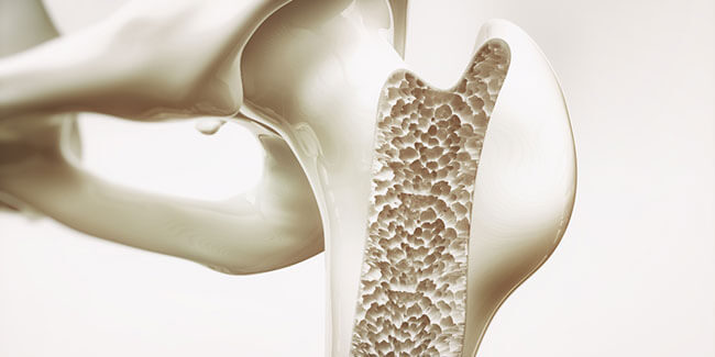 Genetic Prerequisites For Osteoporosis 